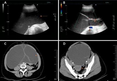 Giant <mark class="highlighted">Ovarian Cysts</mark> Treated by Single-Port Laparoscopic Surgery: A Case Series